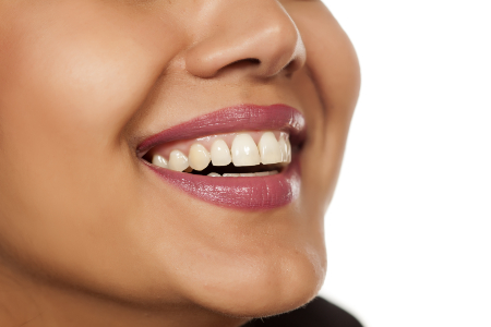 Smiling Woman with Porcelain Veneers